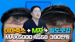 M자탈모 이마 축소 모발이식비용 MAX5000 4558모이식 390만원한시적 [upl. by Anomahs]