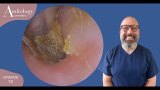 DRY EAR WAX PLUGS amp RETRACTED EARDRUM  EP731 [upl. by Torruella]