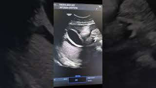 ultrasonography sonography video ultrasound viralvideo [upl. by Tollmann]