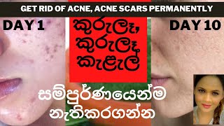 acne treatment  remove acne acne scars black spots  remove pimples home remedy 100 Works [upl. by Masterson729]