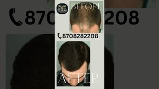 Hair Treatment Before amp After  Dr Grewal  8708282208 shorts viralvideo [upl. by Mcnamara]