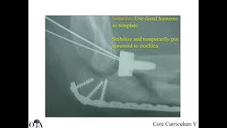 Olecranon fractures  2 of 2 [upl. by Fidelas]