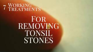 7 smashing treatments for Tonsil stone Removal [upl. by Engenia]