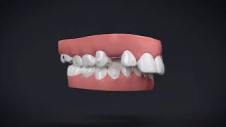 Invisalign® Treatment with Manidublar Advancement [upl. by Kcirdnekal]