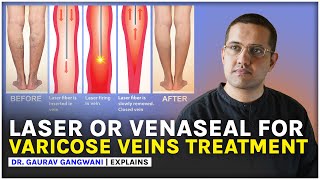 VARICOSE VEINS TREATMENT  LASER ABLATION amp VENASEAL  Dr Gaurav Gangwani [upl. by Ynnig258]