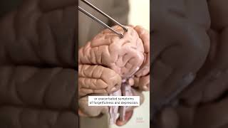 Live Parasitic Worm Removed From Woman’s Brain shorts [upl. by Darsey]