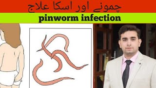 Enterobiasispinworm infection amp Treatmentچمونے اور ان کا علاج Series of common opd cases [upl. by Ydok]