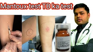 Mantoux Test in Hindi  Tuberculin Skin Test  mantoux test results reading tuberculosis tbt [upl. by Akeihsat]