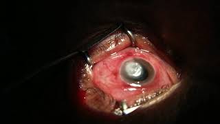 Fungal keratitis intrastromal antifungal therapy [upl. by Devaj]