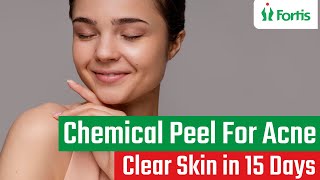 Part 2Chemical Peel  Skin Peeling TreatmentChemical Peel For AcneChemical Peel For Acne ScarMUL [upl. by Lladnarc]