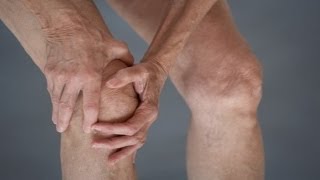 Reversing Arthritis  Treatment For Osteoarthritis [upl. by Haldes]