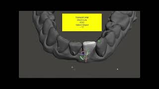 Refinement of Aligners with Meshmixer [upl. by Nnaycnan]