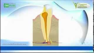 La Ciste Dentale o il Granuloma [upl. by Wilson]