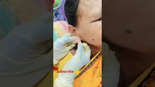 Earlobe repair treatment earloberepair viralvideo shortsvideo youtubeshorts [upl. by Lynnette]