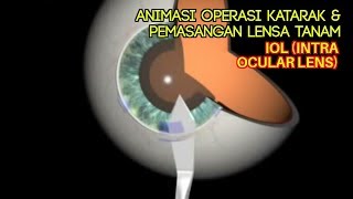 Operasi Bedah Katarak Dalam Animasi dan Pemasangan IOL  Intra Ocular Lens [upl. by Swithbert316]