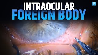 How Intraocular Foreign Body are Removed Scrubtalks [upl. by Anilev525]