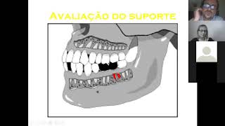 Princípios das Próteses fixas Resumo [upl. by Haggerty]