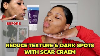 Mederma Cream for Acne Scars  My 2 Week Transformation [upl. by Elyak191]