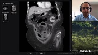 Isolation tutorial Abdominal CT 2 with Vikas Shah [upl. by Hteb]