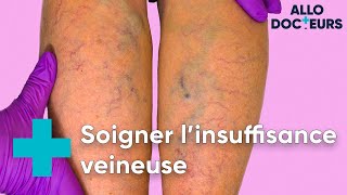 Jambes lourdes varices il existe des solutions  Allo Docteurs [upl. by Meldoh]