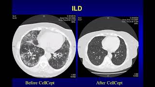 New and Emerging Treatments in Dermatomyositis [upl. by Abeu417]