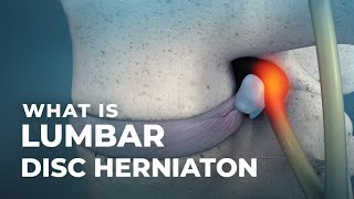 What is Lumbar Disc Herniation  Atlantic Spine Center [upl. by Eniladam]