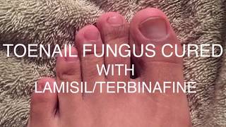 Toenail Fungus BeforeAfter  LamisilTerbinafine 2019 [upl. by Norty]