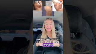 Ritenzione idrica cellulite o grasso [upl. by Eseila]