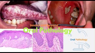 Pindborg Tumor Calcifying Epithelial Odontogenic Tumor 2024 [upl. by Henrie]