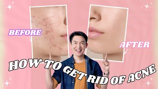 Clear Skin Secrets How to Get Rid of Acne🎀  2024  skincare acne problems skin beauty skincare [upl. by Egiap]