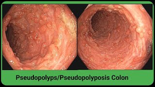 Pseudopolyps Of Colon  Ulcerative Colitis  Pseudopolyposis BDENDOSCOPY [upl. by Llij111]