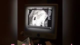 Ultrasound at 5 weeks 3 days [upl. by Kotz167]