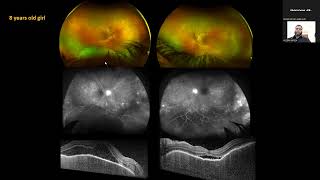 quotWINDOW PERIOD CONCEPTquot IN VOGT KOYANAGI HARADA SYNDROME EYE [upl. by Chrysa]