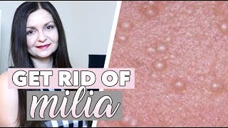 How to Get Rid of Milia  Hard White Bumps on Face  Milia Around Eyes [upl. by Mattox]