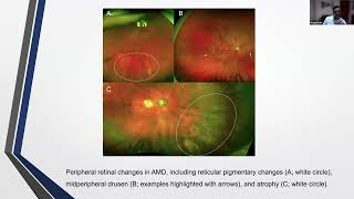 Geographic Atrophy amp AgeRelated Macular Degeneration Optimising Disease Management in Primary Care [upl. by Ebberta]