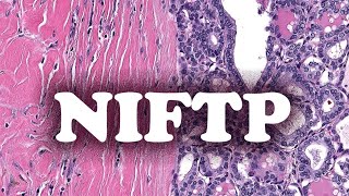 LE NEOPLASME FOLLICULAIRE AVEC CARACTERISTIQUES NUCLEAIRES PAPILLAIRESLIKE NIFTP  PATHOLOGIE [upl. by Isleen405]