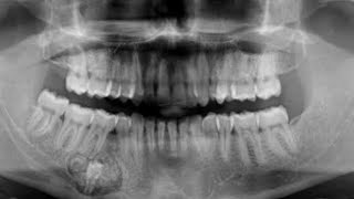 Calcifying Epithelial Odontogenic Tumor Pindborg tumor  III BDS Oral Pathology  RGUHS [upl. by Barstow]