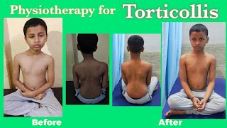 Torticollis Physiotherapy treatmentWry Neck Exercises Torticollis stretching exercises [upl. by Luann]