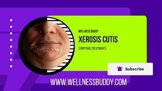 Xerosis Cutis Severe Dry Skin Calluses and Fissures [upl. by Bonneau]