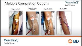 BD WavelinQ™ EndoAVF Cannulation Inservice Training [upl. by Corry590]