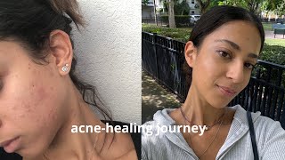 How Do I Maintain a Healthy Skin Care Routine After Dealing With Acne [upl. by Saltsman652]