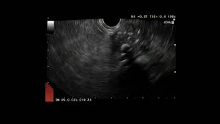 EUS FNA of Pancreas Tail Cancer Adenocarcinoma [upl. by Fitting]