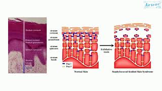 staphylococcal scalded skin syndrome [upl. by Straub]