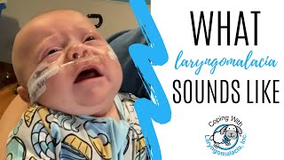 What Laryngomalacia Sounds Like  noisy breathing  newborn congestion [upl. by Kutzer]