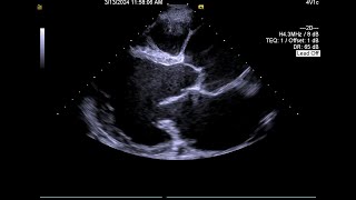 Case 8 Aneurysmally dilated aorta in Marfan syndrome [upl. by Aicarg]