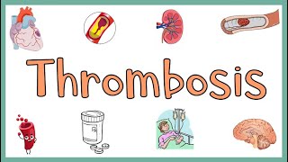 Thrombosis  Definition Causes Types Morphology Fate of a Thrombus amp Clinical manifestations [upl. by Esilahc]