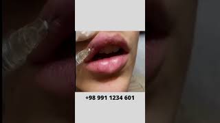 How to Fill In Your Lips  Lip Filler Injection [upl. by Elum494]