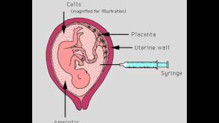 Amniocentesis Amniotic Fluid Aspiration [upl. by Khajeh]