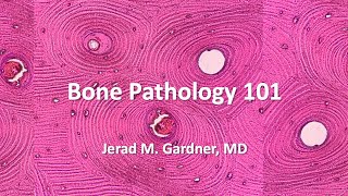 Bone Tumor Pathology 101 Osteosarcoma Chondrosarcoma and Mimics [upl. by Esiahc]