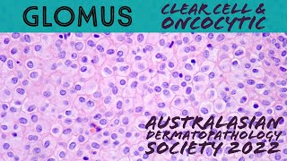 Glomus tumor with oncocytic amp clear cell change mimic skin adnexal tumor dermpath pathology [upl. by Eelahc286]